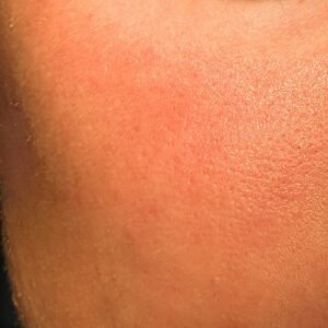 Skin irritation.